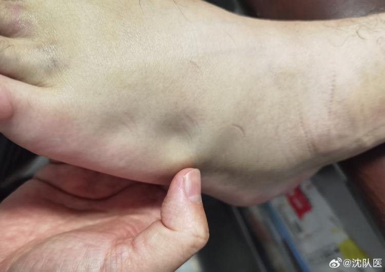 肿胀部位清晰可见|天津津门虎球员明天受伤情况披露