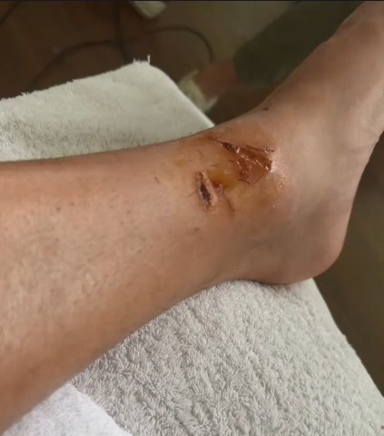 伤口照曝光！李帅坚强面对